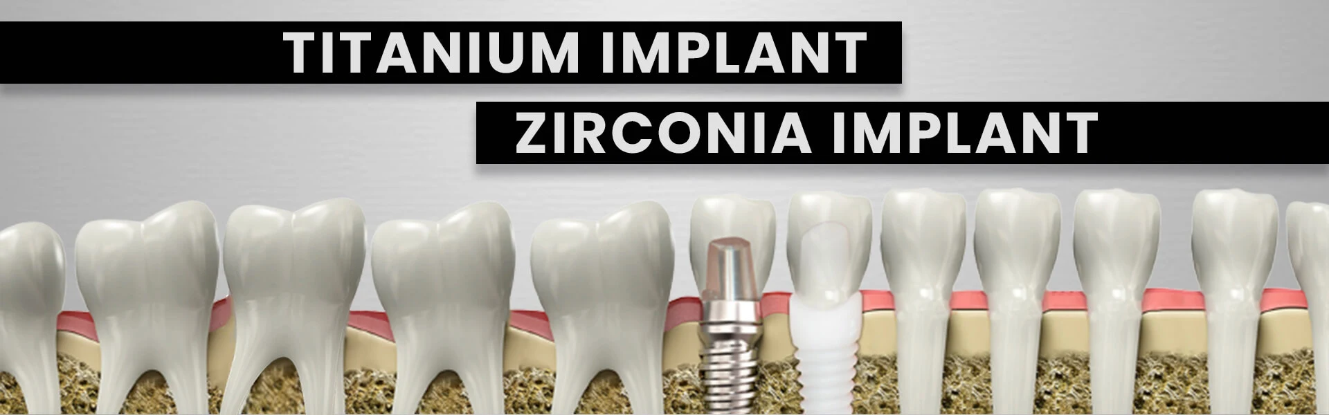 Dental implant solutions at Royal Dental Clinics