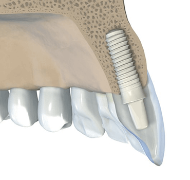 Metal Free Dental Implants – Rule 3